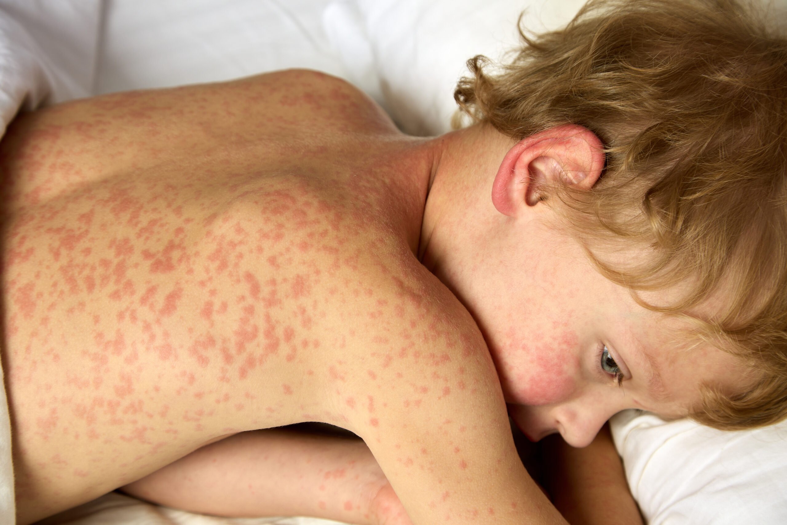 What do we know about the West London measles outbreak?