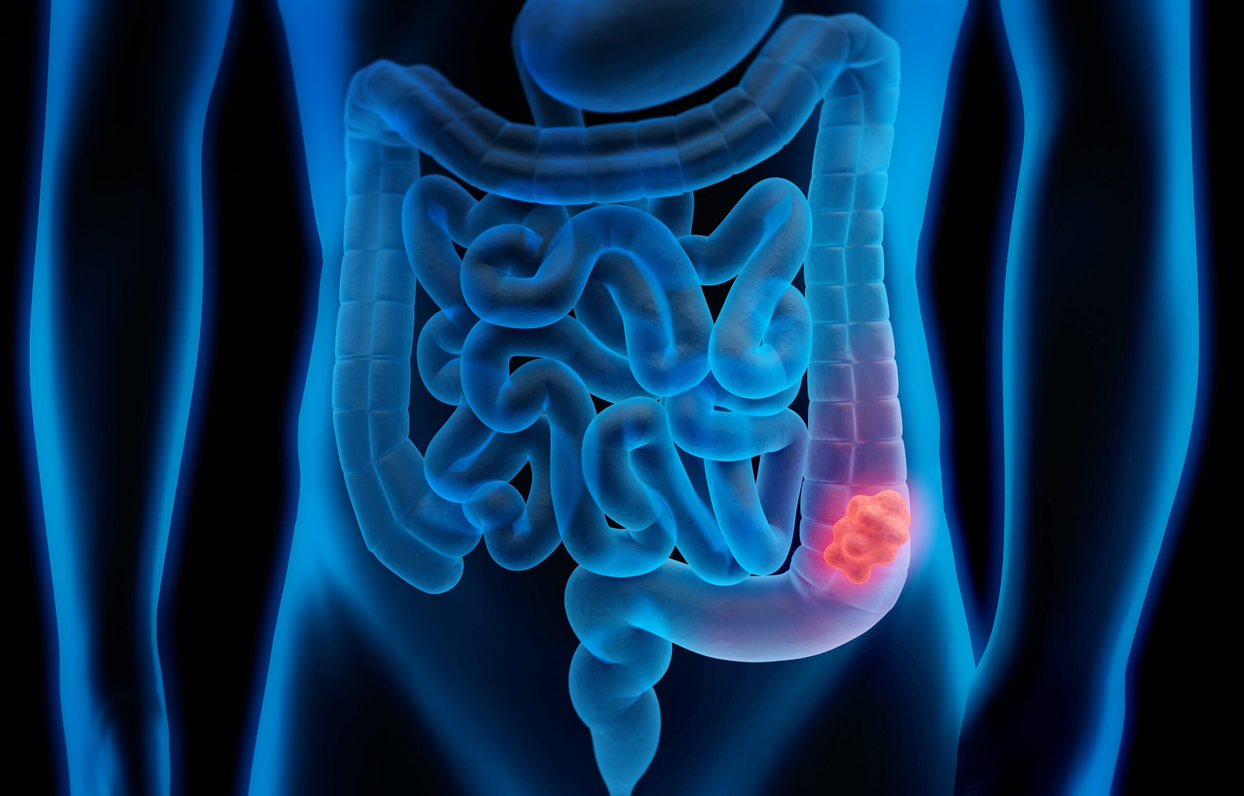 Bowel Cancer Awareness: How to Detect, Prevent, and Manage the Risks