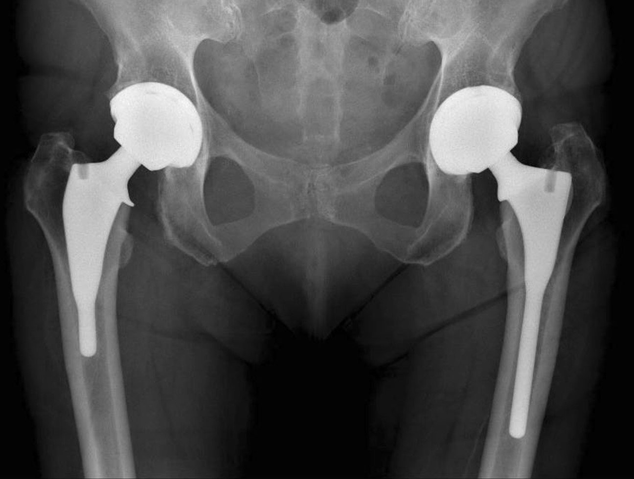 Understanding Knee and Hip Replacements: What You Need to Know