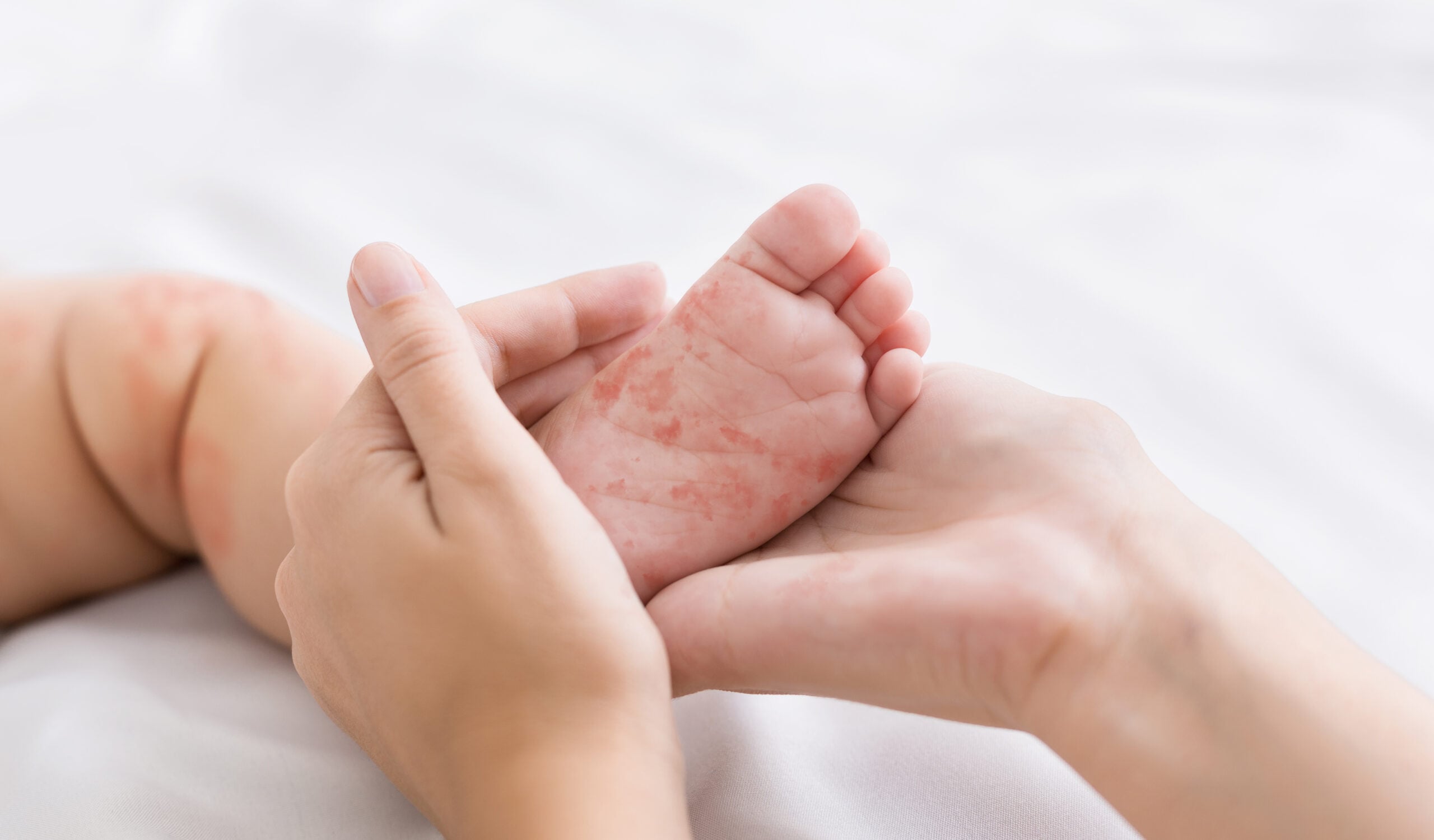 Common Childhood Rashes: A Parent's Guide
